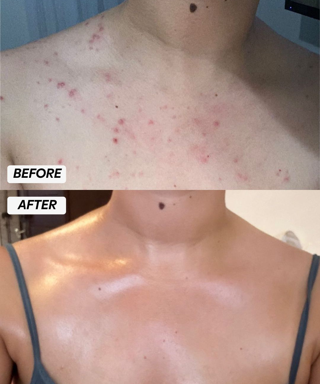 Body Acne