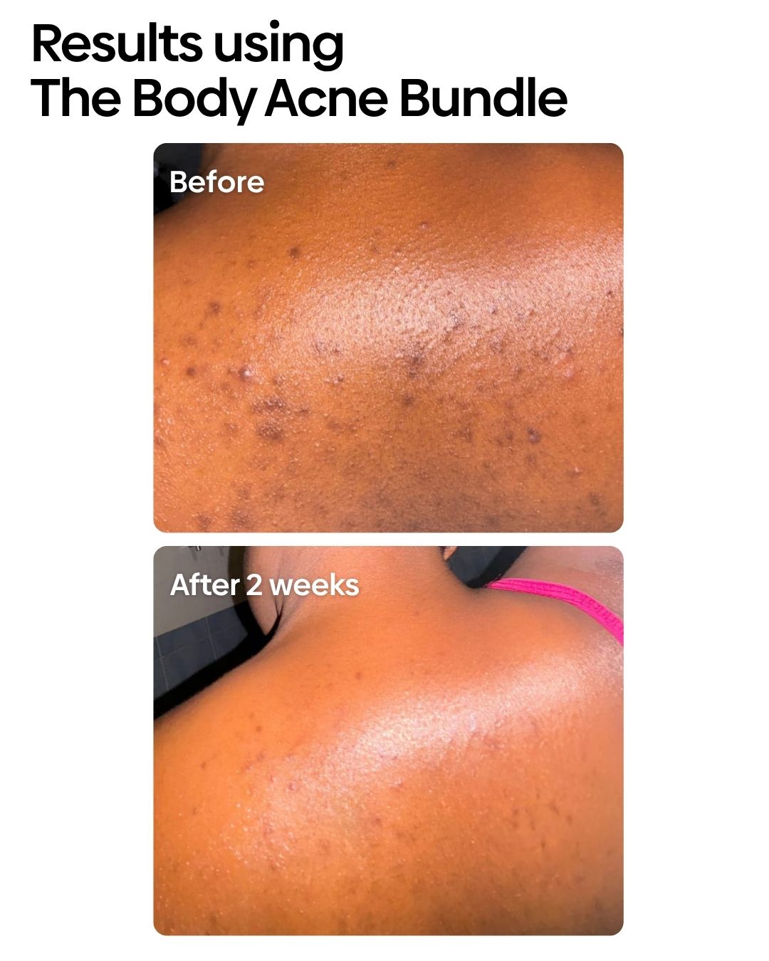 Anti-Body Acne Bundle