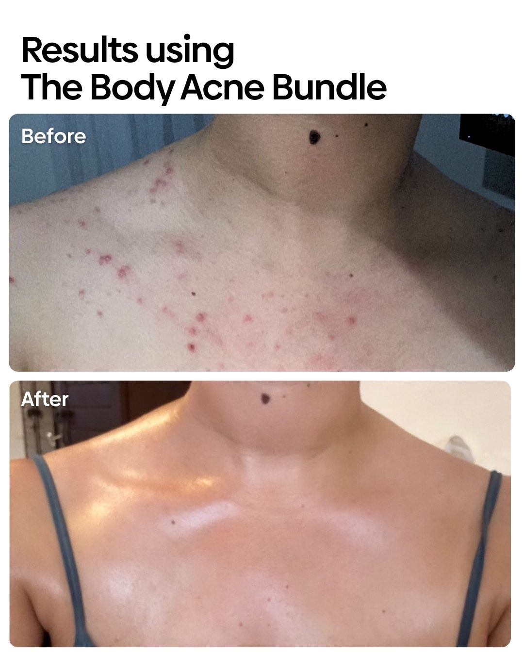 Anti-Body Acne Bundle
