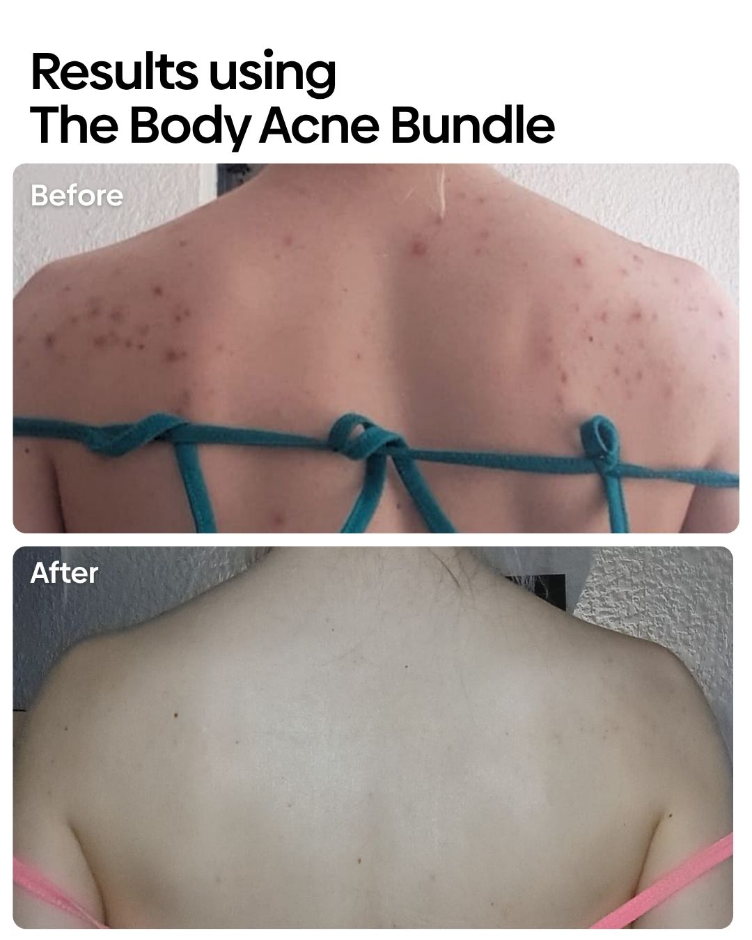Anti-Body Acne Bundle