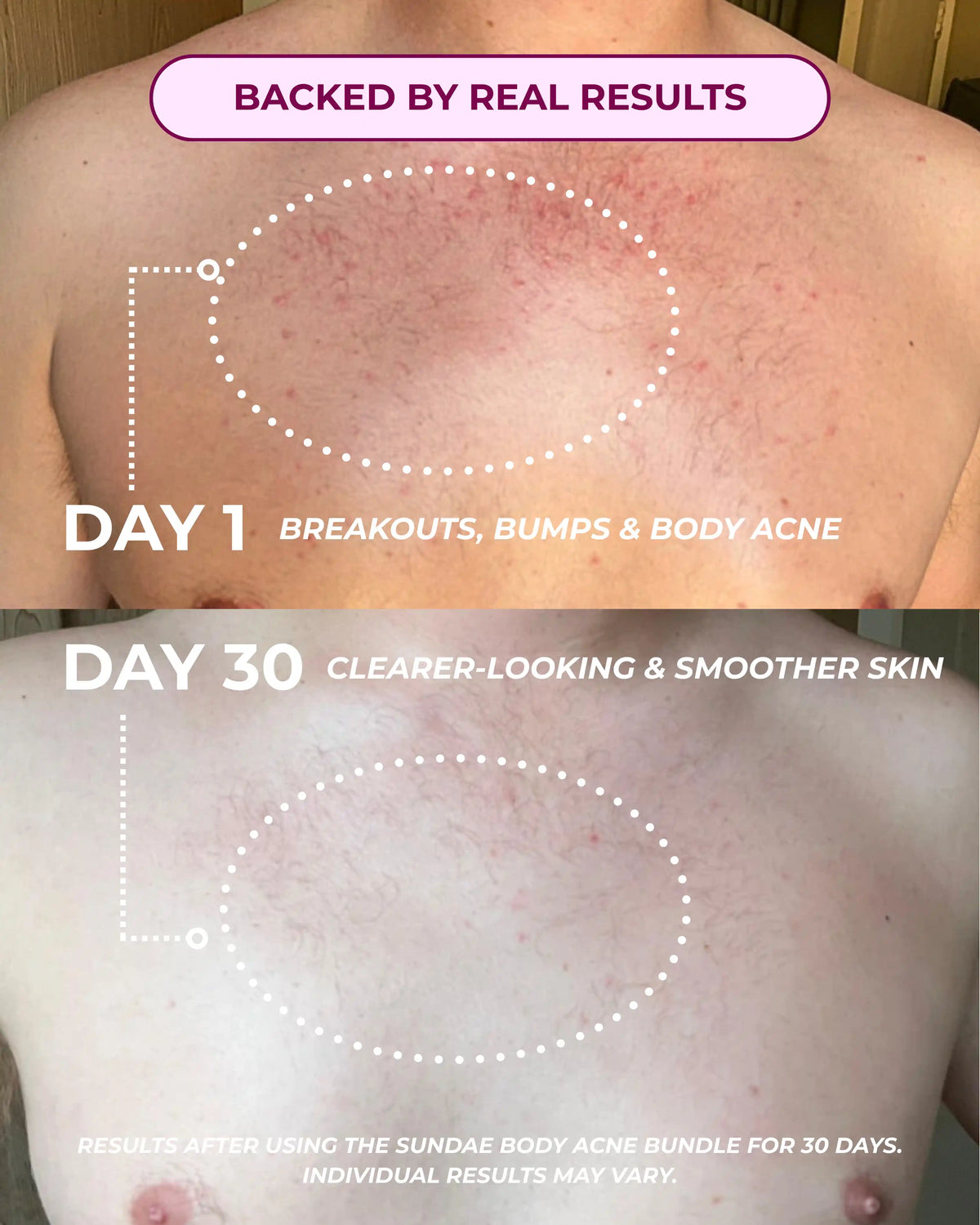 Body Acne Bundle