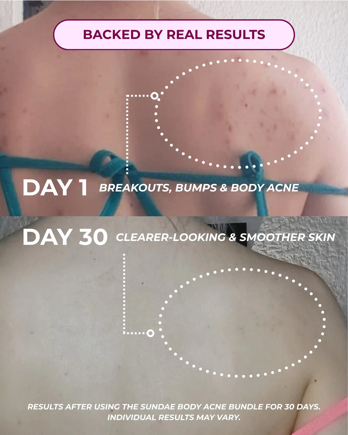 Body Acne Bundle