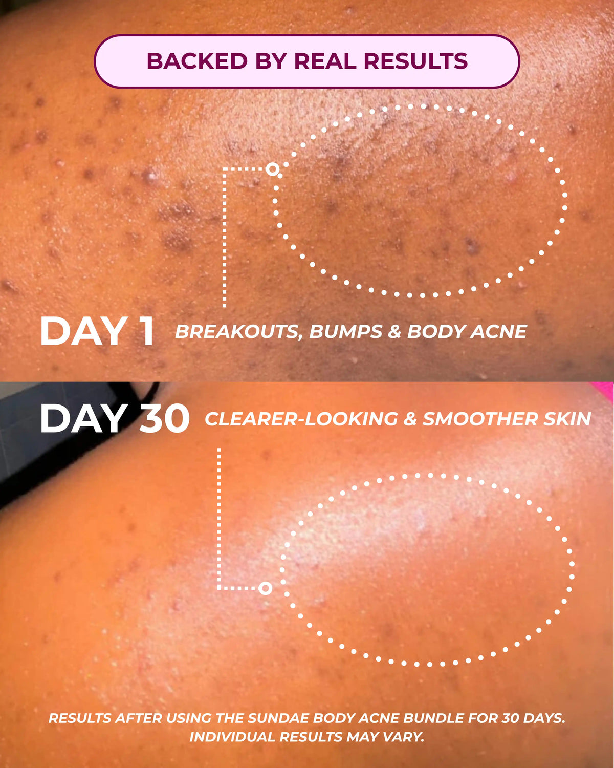 Body Acne Bundle